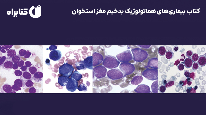 معرفی و دانلود کتاب بیماری‌های هماتولوژیک بدخیم مغز استخوان
